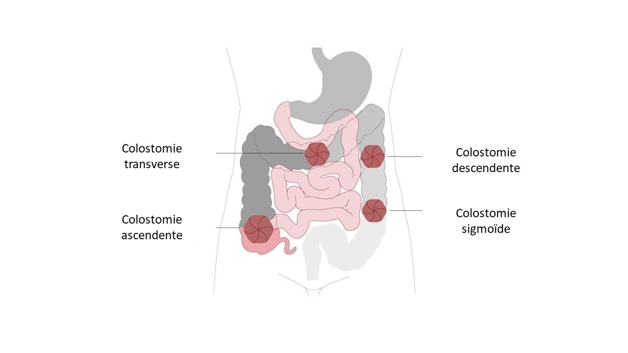illustration de colostomie transversale, descendante, ascendante et sigmoïde