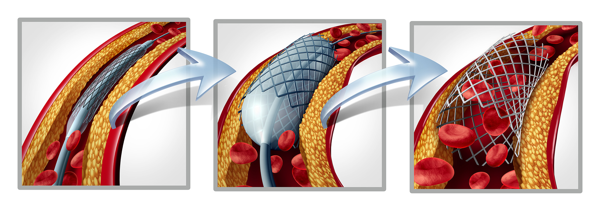 Coronary stent and angioplasty concept as a heart disease treatment symbol diagram with the stages of an implant procedure in an artery that has cholesterol plaque blockage being opened for increased blood flow as a 3D illustration.