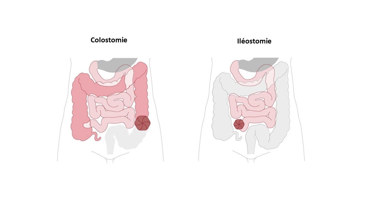 illustration colostomie et iléostomie