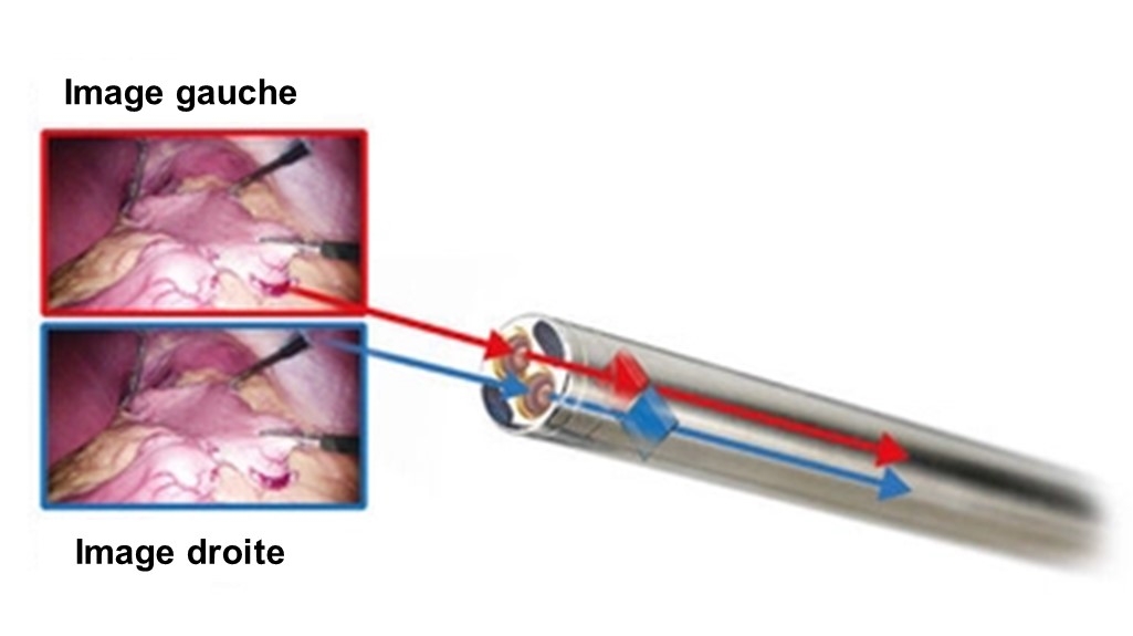 Exemple de systèmes de caméra 3D Chip-on-the-Tip
