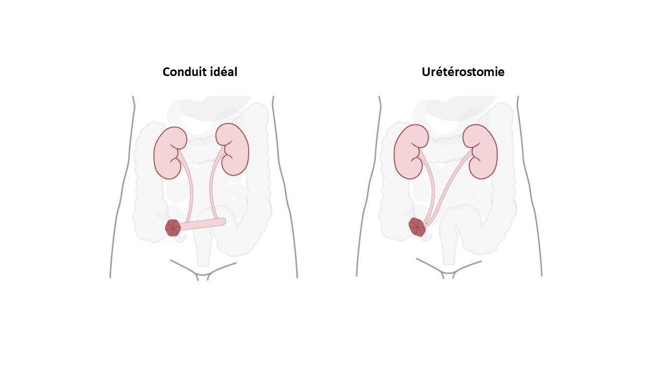 illustration de condui iléal et d’urétérostomie