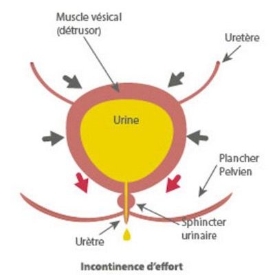 Incontinence urinaire chez l'homme (troubles et fuites urinaires)