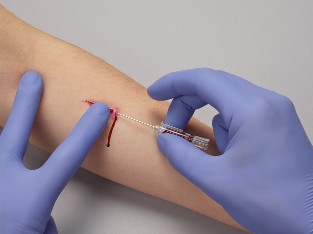 main avec gant chirurgical qui pique une veine avec un cathéter