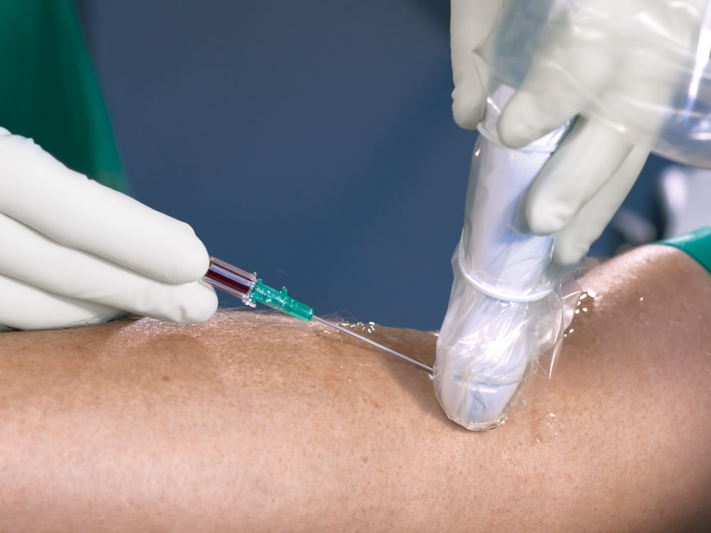 Cathéter veineux périphérique pour accès veineux profonds posé sous échographie