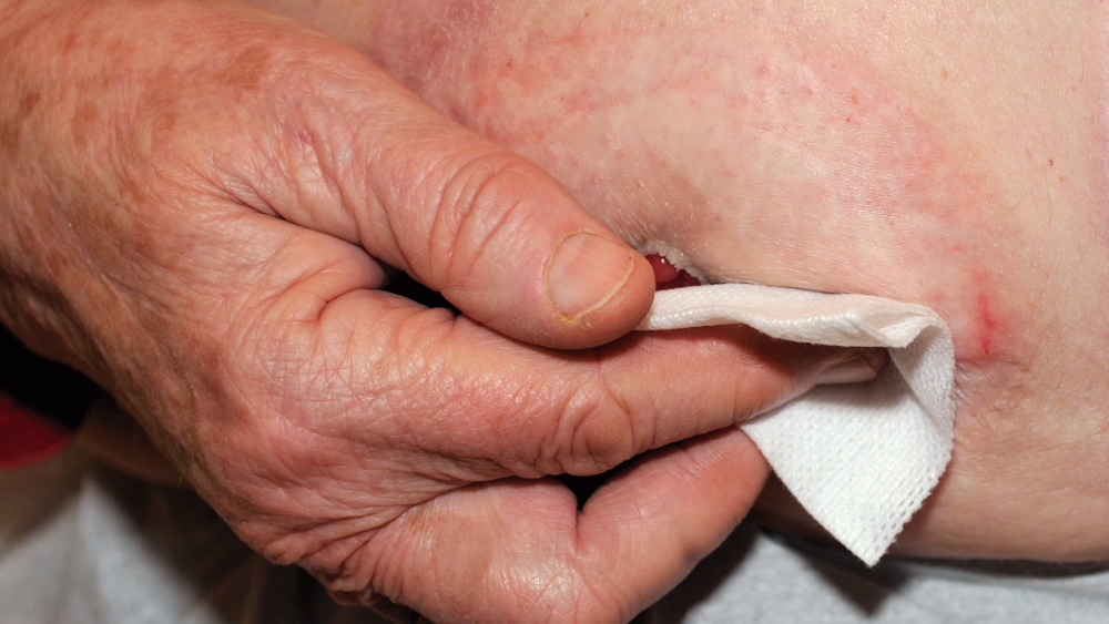 irritiation peau avec poche de stomie avec pansement et main